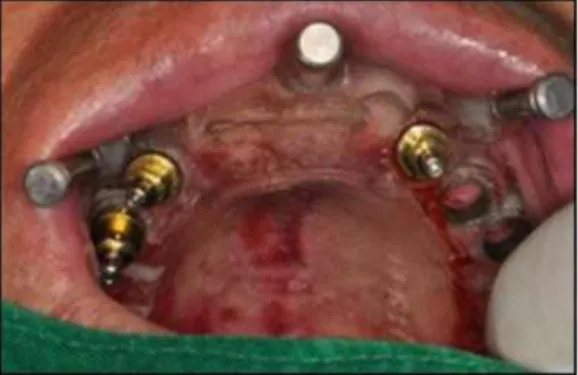 Fig. 15. The surgical template was positioned with the centric relation interocclusal record