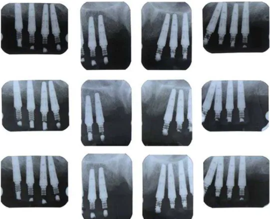 Fig. 22. Periapical views at 1st, 3rd, and 6th month from immediate loading.