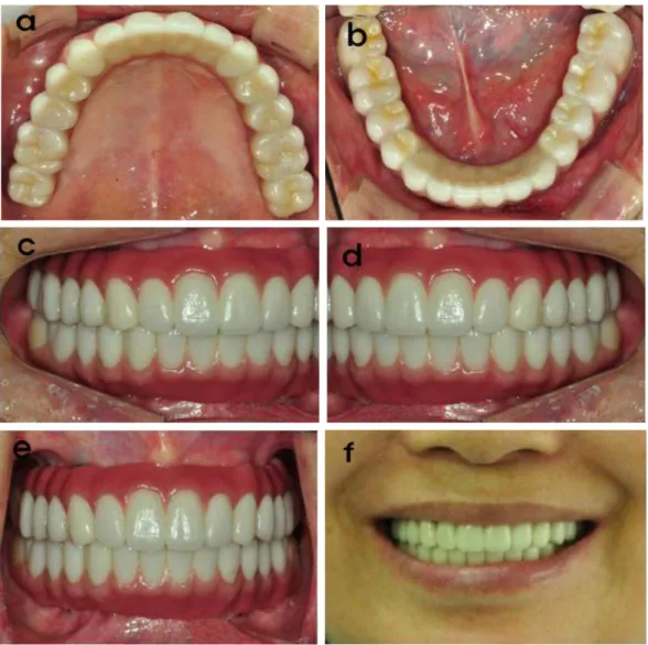 Fig. 17. Esthetics and fuction were restored with the full zirconia restorations.