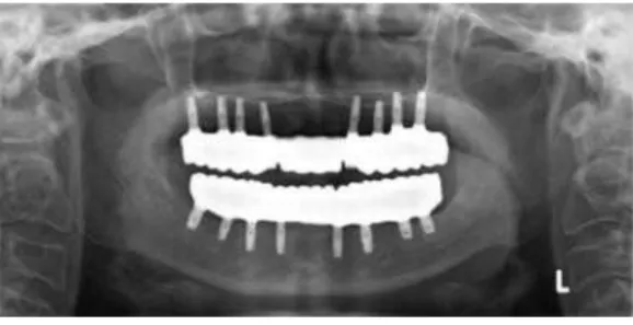 Fig. 19. Radiographic control after 2 years in use showing stable marginal bone at the level of the implants.