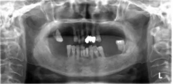 Fig. 1. Residual dentition and bone loss due to advanced periodontal disease.