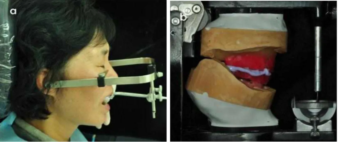 Fig. 7. Vertical dimension &amp; interocclusal centric relation were transferred to a semiadjustable articulator.