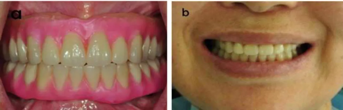 Fig. 8. Diagnostic wax denture try-in for determination of standard esthetic parameters.