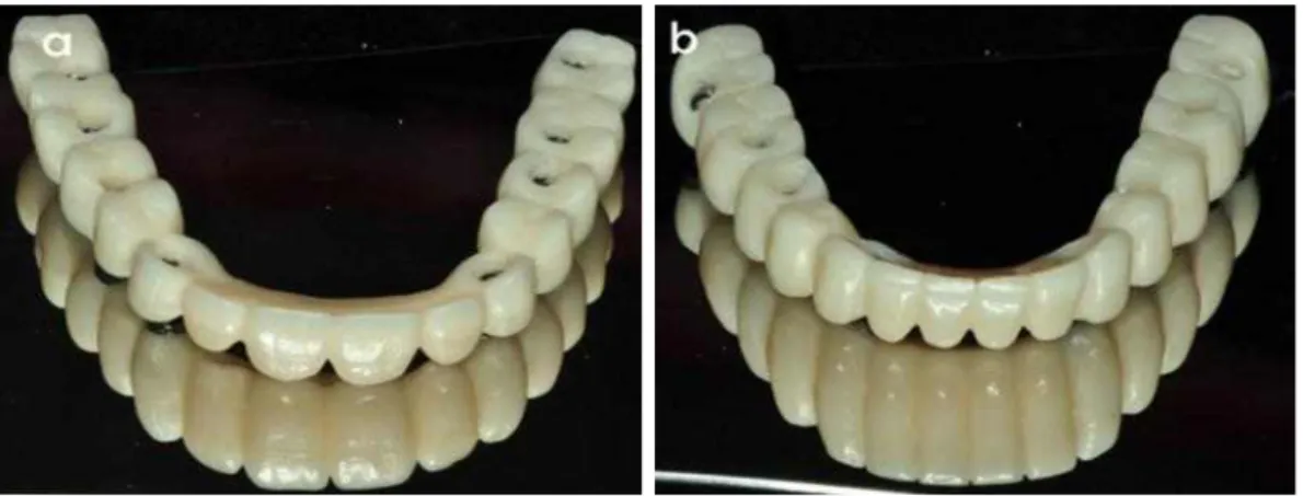 Fig. 10. Fixed detachable interim prostheses duplicated from wax dentures. a) Maxilla b) Mandible