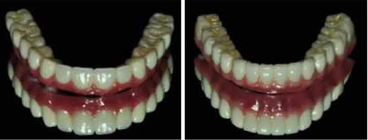Fig. 16. Final prostheses to full zirconia after being veneered of anterior teeth. a) Maxilla b) Mandible