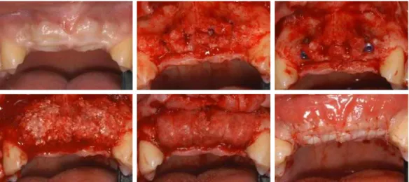 Fig. 2. implant first surgery and bone graft on #12 and #22 a) pre-operation state