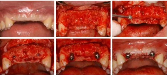 Fig. 3. implant second surgery on #12 and #22