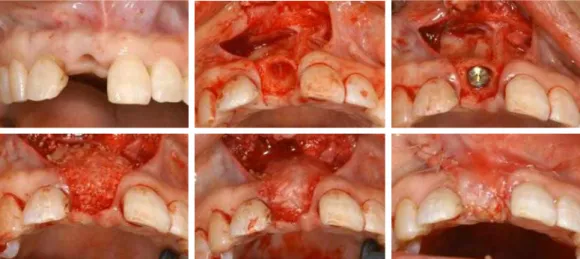 Fig. 6. implant first surgery and bone graft on #11