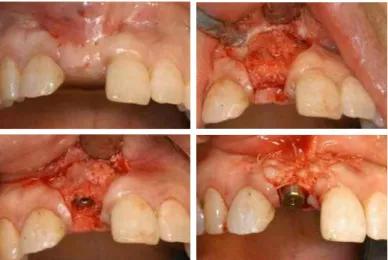 Fig. 7. implant second surgery on #11