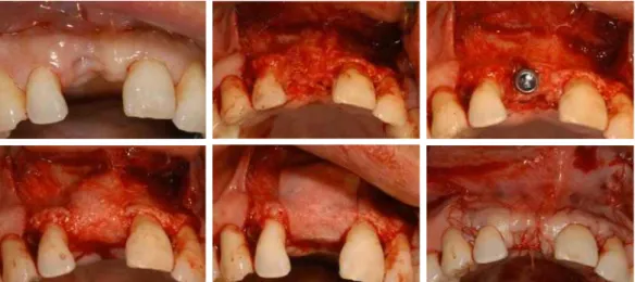 Fig. 10. implant first surgery and bone graft on #11