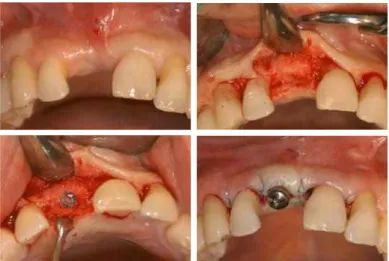 Fig. 11. implant second surgery on #11