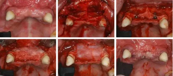 Fig. 14. implant first surgery and bone graft on #12 and #22