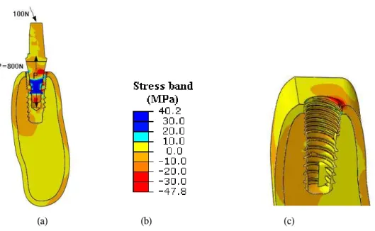 Fig. 7. For preload=800N case. Radial stress distribution across the abutment, implant fixture and bone under an occlusal load of 100N applied at the top surface of abutment at 30 degree with respect to implant axis