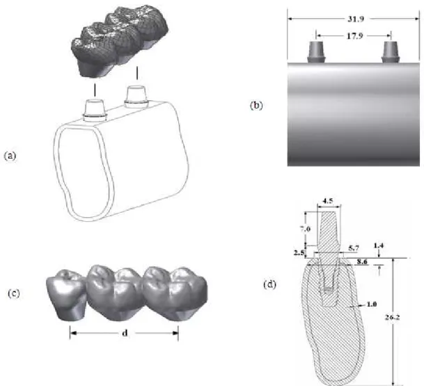 Fig. 1. Geometry model used in this study. (a) Overview of an implant supported 3 unit fixed prosthodontics connecting mandibular #5-#7