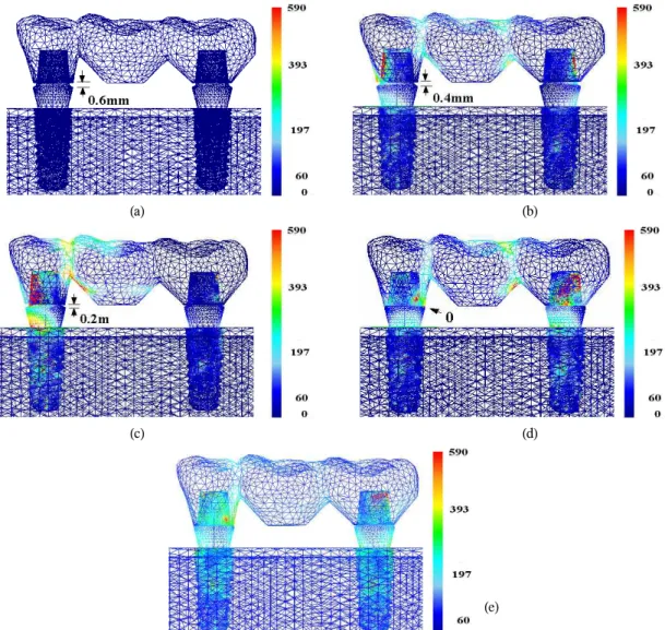 Fig. 3. Von-Mises stress development with the course of the fixed prosthodontics/implant abutment assembly (d=17.8mm)