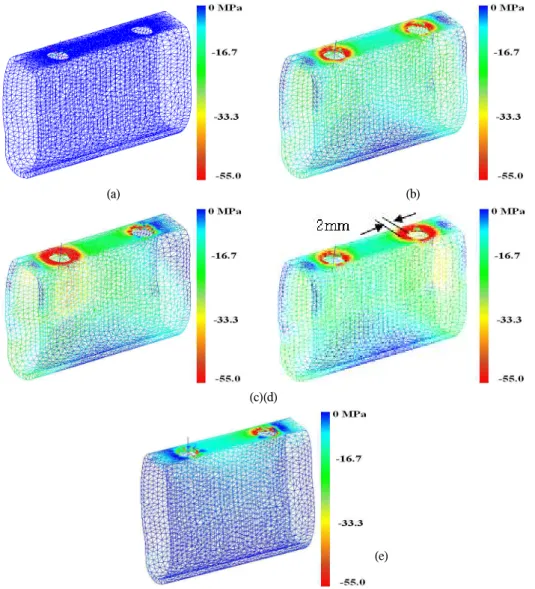 Fig. 4. Maximum compressive stresses in the cortical bone during the fixed prosthodontics/abutment assembly when the fixed prosthodontics is longer than the inter-abutment distance by 0.1mm.