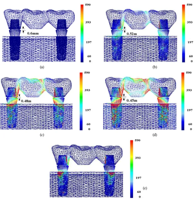 Fig. 5. Von-Mises stress development with the course of the fixed prosthodontics/implant abutment assembly (d=18.0mm)