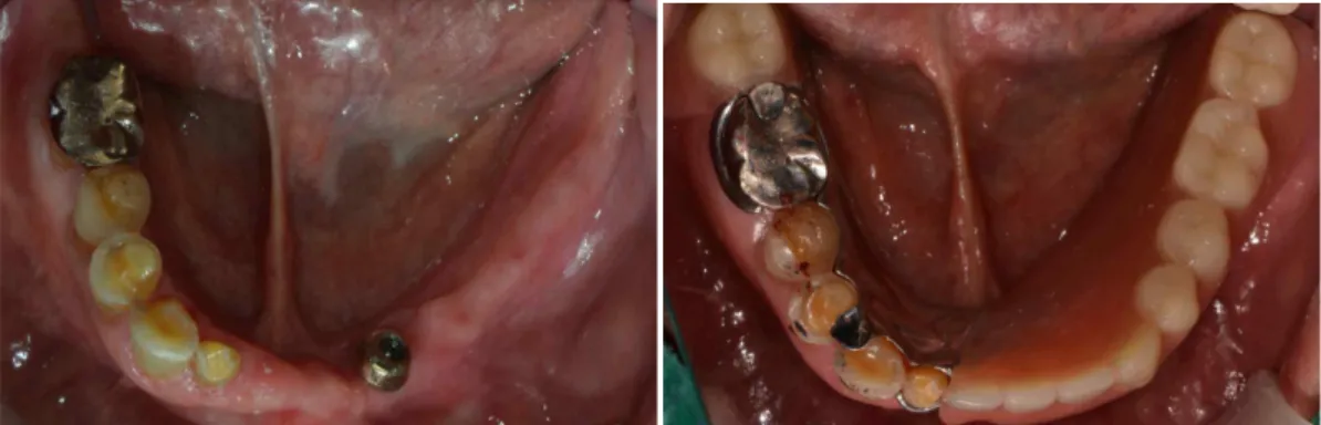 Fig. 2. Implant supported removable partial denture in Kennedy Class II case.