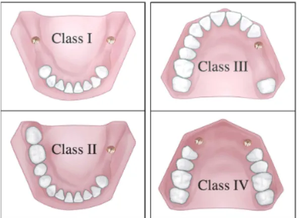 Fig. 4. Various indications of implant assisted removable partial denture.