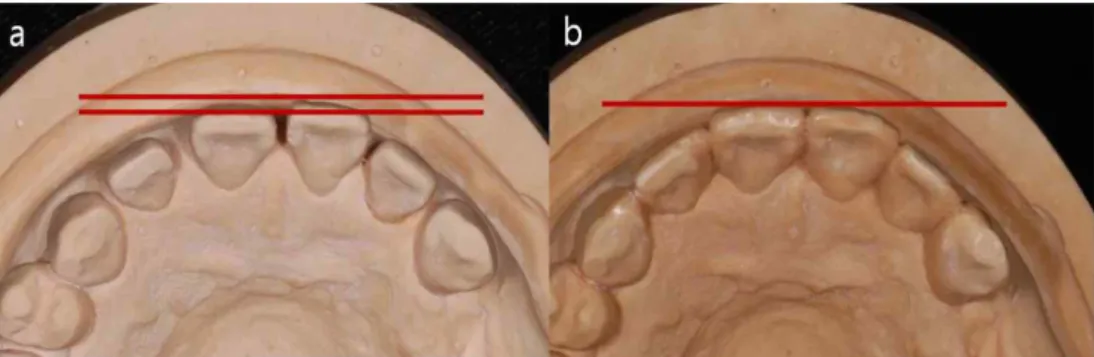 Fig. 2. a, Preliminary cast. b, Wax-up obtained by an addition of wax. 례이다. 공간을 수복한 후에 증가될 치관 너비를 보상하기 위해 치은 절제술을 시행하여 치관의 길이를 연장하였다