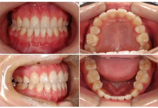 Fig. 2. Debonding intraoral photo.