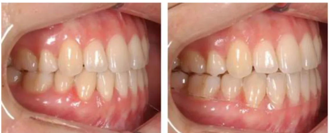 Fig. 5. Clear retainer 로는 치은이 상대적으로 많이 풍융한 상태로 좌 측과 마찬가지로 레이저를 사용하여 함입부 상 피와 협측 치은을 삭제하였다