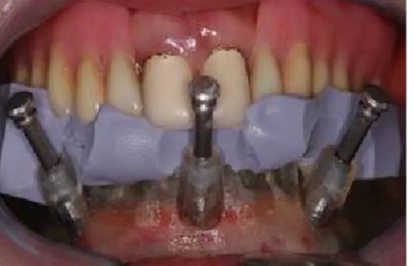 Fig. 6. Mandibular surgical template in situ. The surgical template was positioned with the centric relation interocclusal record (prefabricated on the semiadjustable articulator).