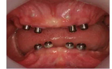 Fig. 3. 4 implants were placed in the upper and lower jaw each.