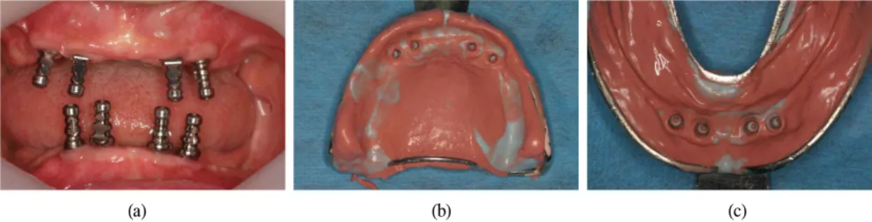 Fig. 5. Pick-up impression coping were connected with Duralay resin on the preliminary cast, and open individual tray was fabricated.