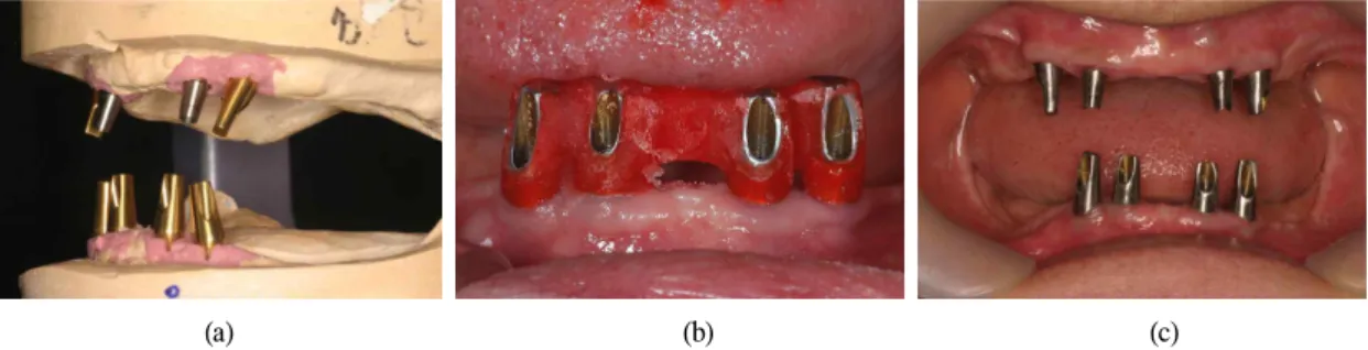 Fig. 8. Proper abutment selection and milling on the model(a) and transferred to the mouth with the resin jig (b,c)