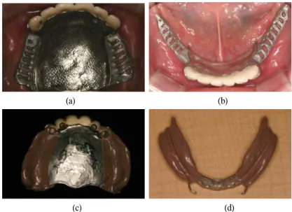 Fig. 10. Metal framework try-in and Impression for altered cast