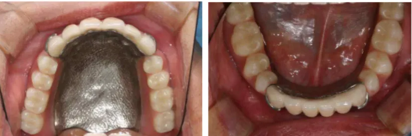 Fig. 12. Final Prostheses : Anterior fixed implant restoration and Distal extension RPD.