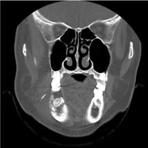 Fig. 2. After tooth extraction, unhealed lesion of that was prolonged during 2 months.