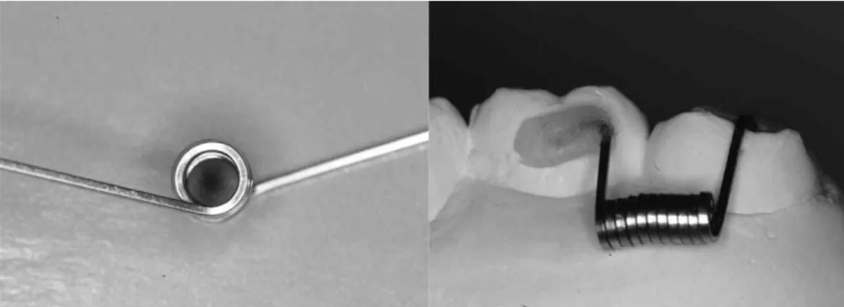 Fig. 1. Application of Dragon helix, for tipping and intruding the maxillary second molar.