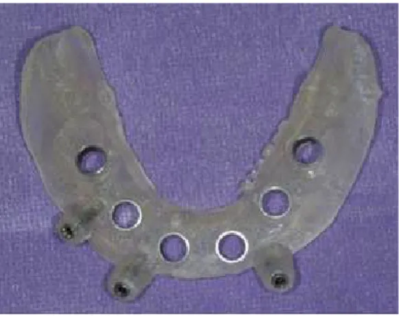 Fig. 2. Surgical template (Patient 4).