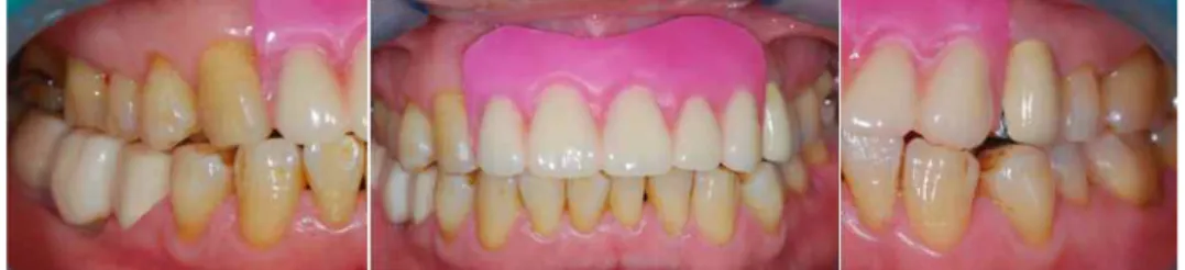 Fig. 19. Wax denture try-in and check occlusal relationshiop in maximal intercuspation and lateral excursion