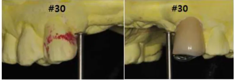 Fig. 22. Rigid retentive areas have an undercut of at least 0.030 inch at a 0°-tilt