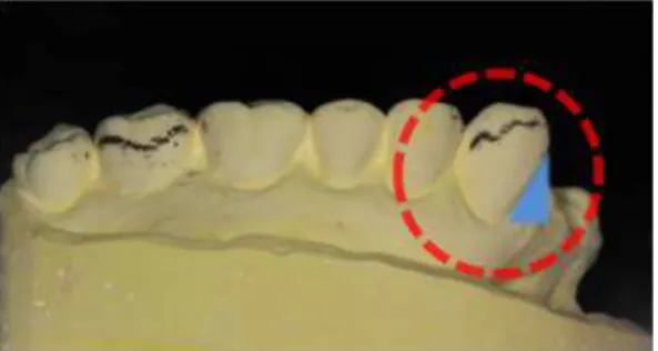 Fig. 3. A desirable undercut at the proximal area of the upper right caninie(#23)