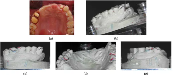 Fig. 5. (a) Intraoral status after the prepartaion of #15,16 teeth and first natural teeth alteration of