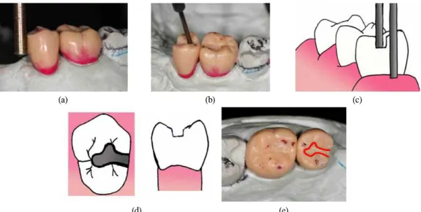 Fig. 6. (a) The occlusal rest should have an undercut of 0.010 inch, (b) the depth of 1.5-2.0mm at least,