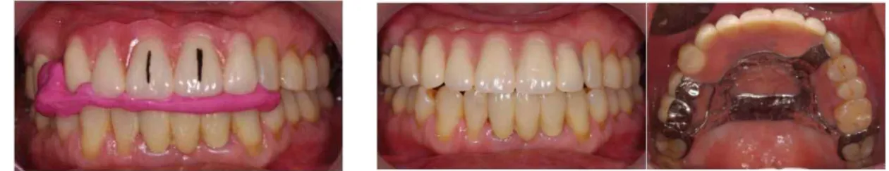 Fig. 8. Wax-denture try-in and registration of occlusal relationship