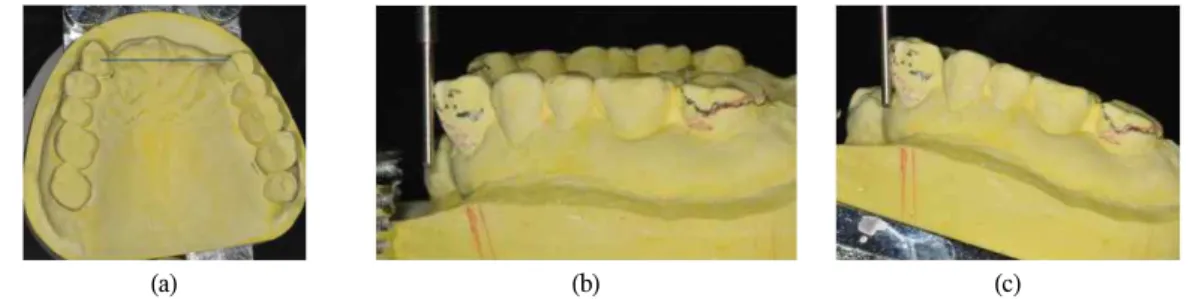 Fig. 16. (a) PVS impression after the preparation of #24 and the first natural teeth alteration of