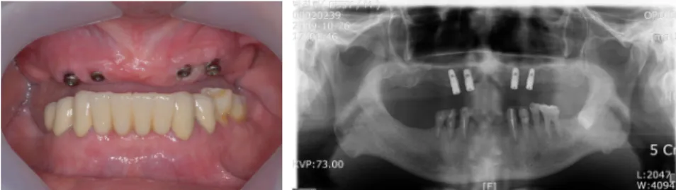 Fig. 2. intraoral view and panoramic radiograph after implants placement.