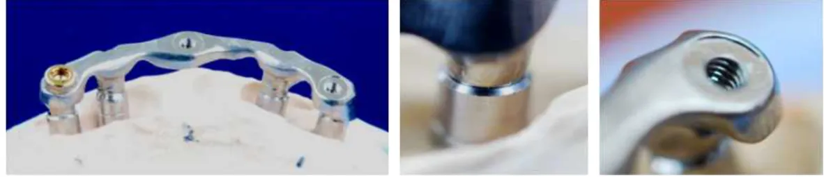 Fig. 7. securing of bar position and tapping for Locator ® attachment.