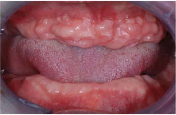 Fig. 1a. Frontal view of edentulous arches at an approximated occluso-vertical dimension.