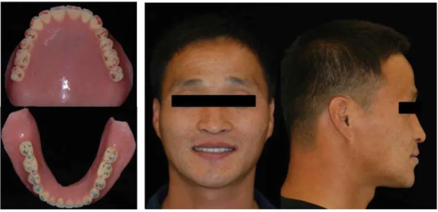 Fig. 2. Provisional dentures. 소선이 낮았으며 점막이 두꺼운 각화점막이어서 고정성 보철물에 적절하다고 판단되었다. 하지 만 입술지지가 불충분하여 연조직을 대체할 필 요성이 있고, 중등도의 골흡수로 인해 후방까지 임플란트를 식립할 수 없다고 판단되었기에 본 증례는 고정성 착탈형(detachable) 보철물로 결정 하였다