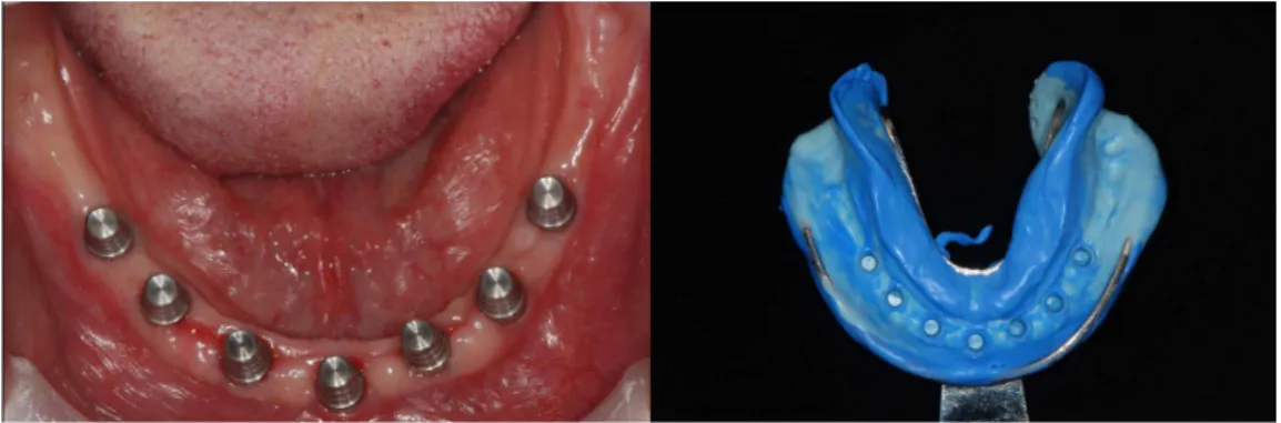 Fig. 5. Primary impression with transfer type impression coping and polyvinyl siloxane작하는데 이용되었다