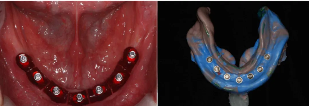 Fig. 6. Final impression with splinted pick-up type impression coping and polyvinyl siloxane.