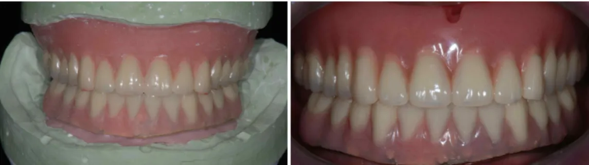 Fig. 10. Definitive prostheses fabrication and try-in.