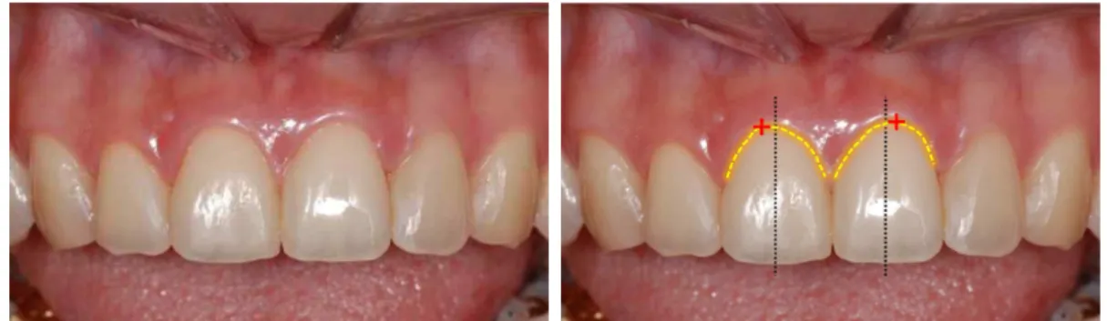 Fig. 1. The gingival zenith is the most apical point of the gingival outline. 를 줌으로서 치아의 경사도과 출현윤곽에 영향 을 미친다